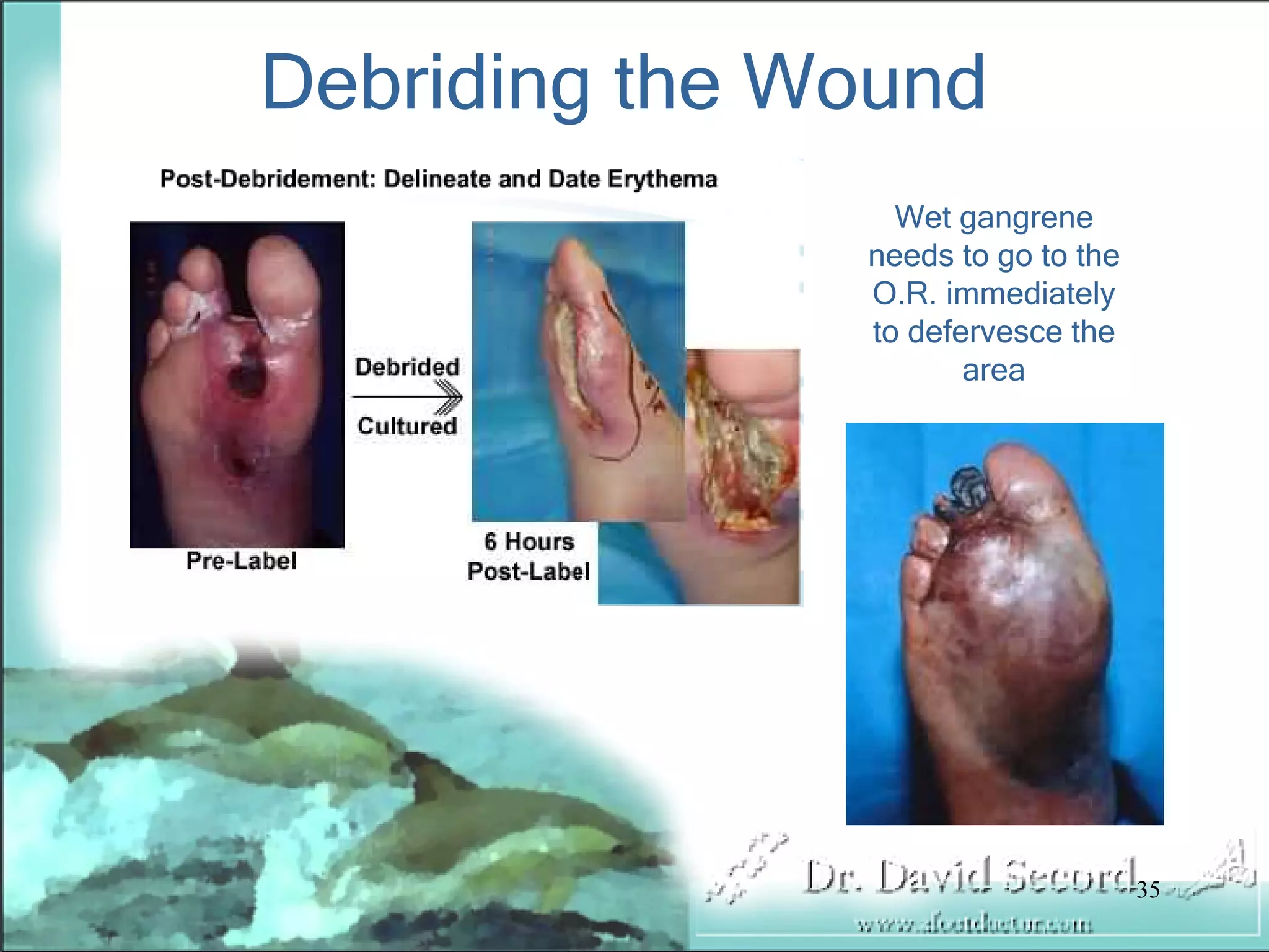Wound Vac Lecture