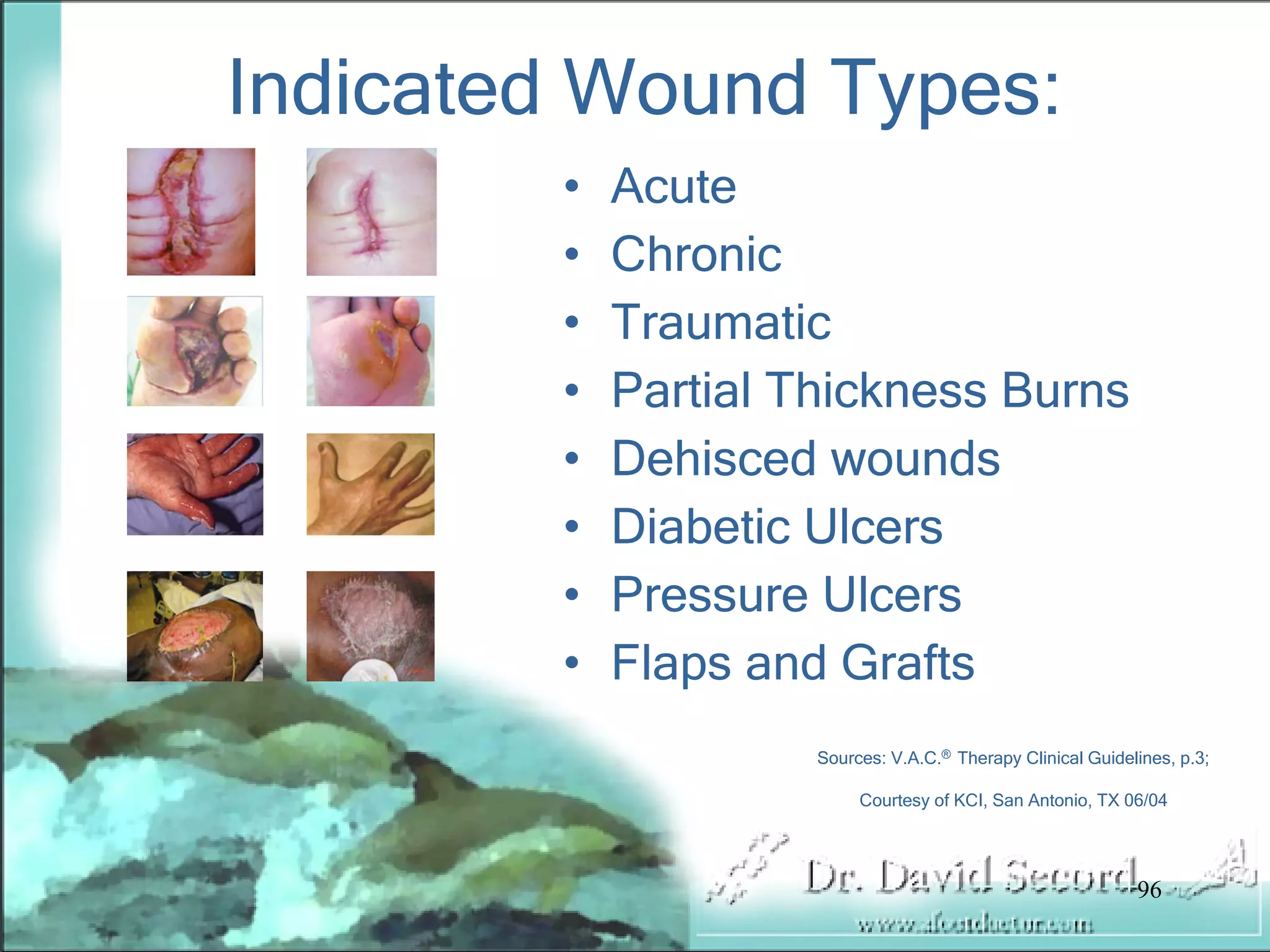 Wound Vac Lecture