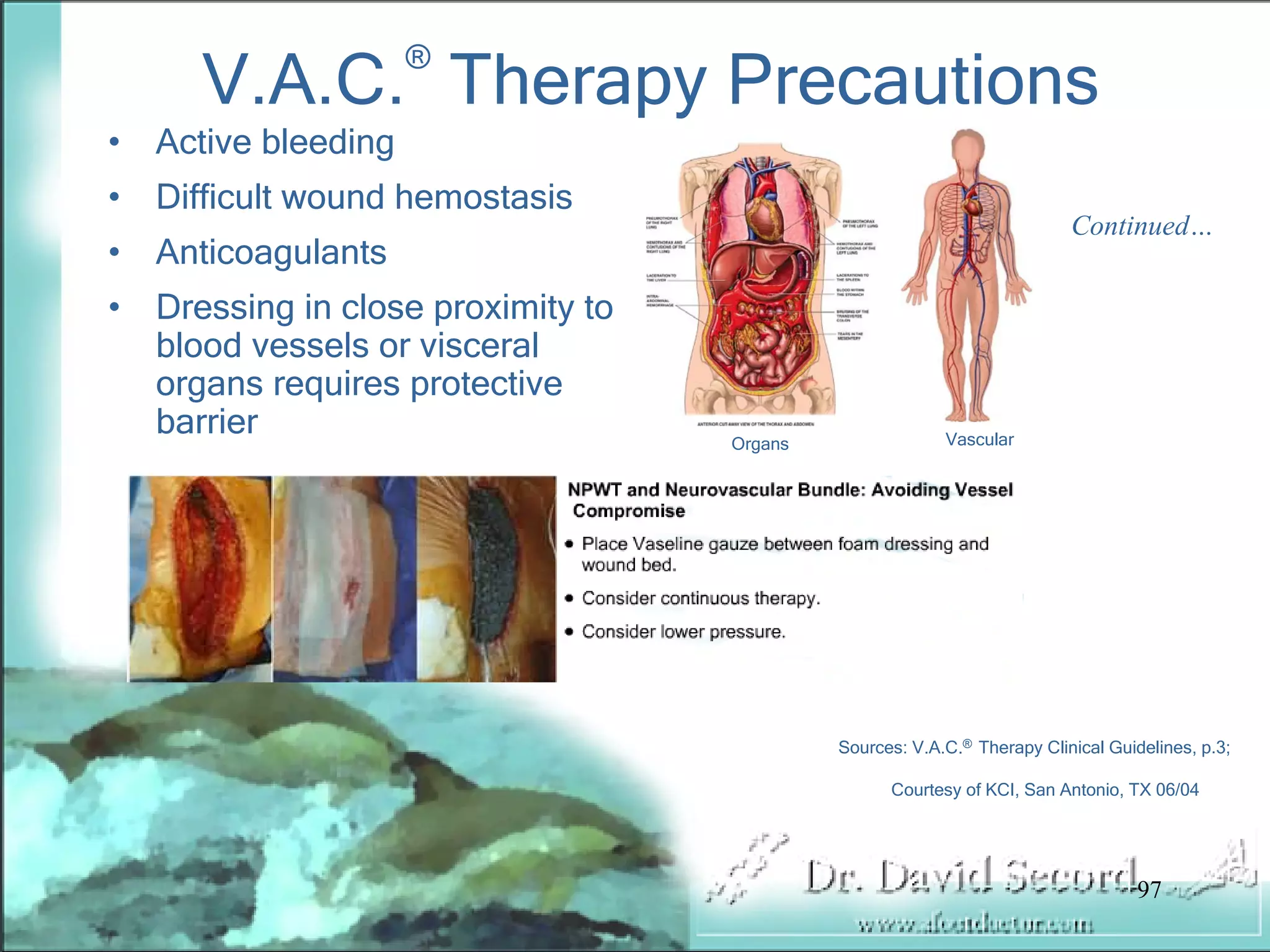 Wound Vac Lecture