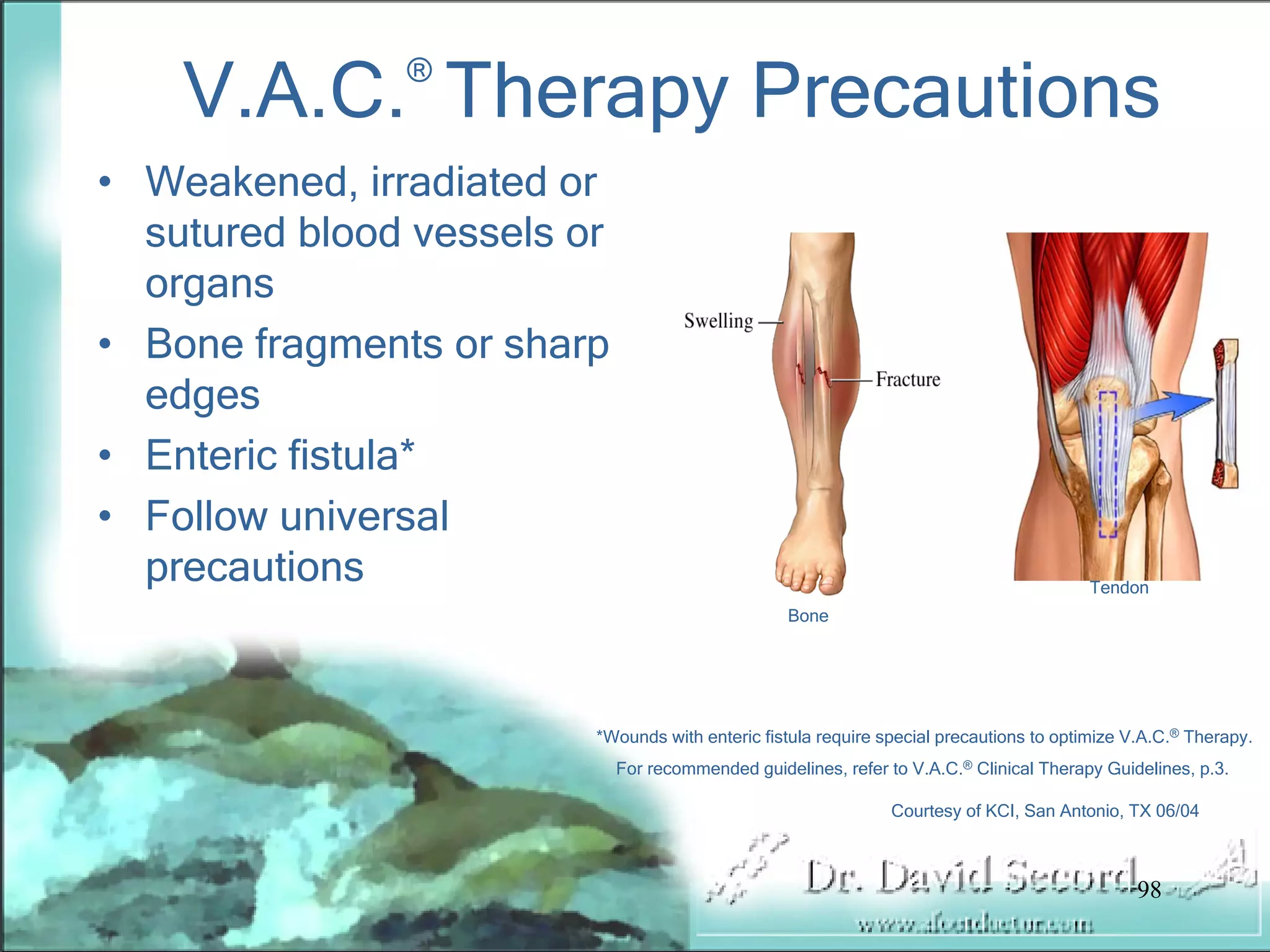 Wound Vac Lecture