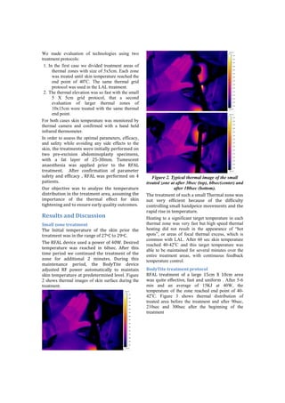 We made evaluation of technologies using two
treatment protocols:
 1. In the first case we divided treatment areas of
      thermal zones with size of 5x5cm. Each zone
      was treated until skin temperature reached the
      end point of 40oC. The same thermal grid
      protocol was used in the LAL treatment.
 2. The thermal elevation was so fast with the small
      5 X 5cm grid protocol, that a second
      evaluation of larger thermal zones of
      10x15cm were treated with the same thermal
      end point.
For both cases skin temperature was monitored by
thermal camera and confirmed with a hand held
infrared thermometer.
In order to assess the optimal parameters, efficacy,
and safety while avoiding any side effects to the
skin, .2/!.$/(.;/&.,!K/$/!%&%.%())6!*/$:+$;/"!+&!
.K+! *$/D/H-%,%+&! (A"+;%&+*)(,.6! ,*/-%;/&,5!
K%.2! (! :(.! )(6/$! +:! M8DP9;;0! G#;/,-/&.!
(&(/,.2/,%(! K(,! (**)%/"! *$%+$! .+! .2/! ?@J<!
.$/(.;/&.0! ! J:./$! -+&:%$;(.%+&! +:! *($(;/./$!
,(:/.6! (&"! /::%-(-6! 5! ?@J<! K(,! */$:+$;/"! +&! E!      Figure 2. Typical thermal image of the small
*(.%/&.,0!                                               treated zone at after 30sec (top), 60sec(center) and
Q#$! +AR/-.%>/! K(,! .+! (&()6L/! .2/! ./;*/$(.#$/!                     after 180sec (bottom).
"%,.$%A#.%+&!%&!.2/!.$/(.;/&.!($/(5!(,,#;%&'!.2/!        G2/!.$/(.;/&.!+:!,#-2!(!,;())!G2/$;()!L+&/!K(,!
%;*+$.(&-/! +:! .2/! .2/$;()! /::/-.! :+$! ,=%&!         &+.! >/$6! /::%-%/&.! A/-(#,/! +:! .2/! "%::%-#).6!
.%'2./&%&'!(&"!.+!/&,#$/!/($)6!S#()%.6!+#.-+;/,0!        -+&.$+))%&'!,;())!2(&"*/%-/!;+>/;/&.,!(&"!.2/!
                                                         $(*%"!$%,/!%&!./;*/$(.#$/0!
Results!and!Discussion!                                  Heating to a significant target temperature in each
Small!zone!treatment!                                    thermal zone was very fast but high speed thermal
G2/! 1&%.%()! ./;*/$(.#$/! +:! .2/! ,=%&! *$%+$! .2/!    heating did not result in the appearance of “hot
.$/(.;/&.!K(,!%&!.2/!$(&'/!+:!M7+N!.+!MT+N0!!            spots”, or areas of focal thermal excess, which is
                                                         common with LAL. After 60 sec skin temperature
G2/!?@J<!"/>%-/!#,/"!(!*+K/$!+:!E9O0!U/,%$/"!
                                                         reached 40-42oC and this target temperature was
./;*/$(.#$/! K(,! $/(-2/"! %&! I9,/-0! J:./$! .2%,!      able to be maintained for several minutes over the
.%;/! */$%+"! K/! -+&.%&#/"! .2/! .$/(.;/&.! +:! .2/!    entire treatment areas, with continuous feedback
L+&/! :+$! (""%.%+&()! M! ;%&#./,0! U#$%&'! .2%,!        temperature control.
;(%&./&(&-/! */$%+"5! .2/! V+"6G%./! "/>%-/!
("R#,./"! ?@! *+K/$! (#.+;(.%-())6! .+! ;(%&.(%&!        BodyTite!treatment!protocol!
,=%&!./;*/$(.#$/!(.!*$/"/./$;%&/"!)/>/). Figure          ?@J<! .$/(.;/&.! +:! (! )($'/! C8-;! W! C9-;! ($/(!
2 shows thermal images of skin surface during the        K(,! S#%./! /::/-.%>/5! :(,.! (&"! #&%:+$;!. After 5-6
treatment.                                               min and an average of 15KJ at 40W, the
                                                         temperature of the zone reached end point of 40-
                                                         42oC. Figure 3 shows thermal distribution of
                                                         treated area before the treatment and after 90sec,
                                                         210sec and 300sec after the beginning of the
                                                         treatment
 