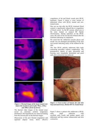 coagulation of fat and blood vessels post RFAL
                                                       treatment. Figure 4 shows a cross section of
                                                       abdominal tissue with RFAL treated and non-
                                                       treated zones.
                                                       One can see that after the RFAL treatment blood
                                                       content is significantly reduced due to coagulation
                                                       of blood vessels by the RF current, which acts in
                                                       the same manner as surgical RF bipolar
                                                       electrocautery. During aspiration of the RFAL
                                                       cases, the color of fat was devoid of blood after the
                                                       treatment indicating its coagulation.
                                                       We noted that the subdermal vascular plexus and
                                                       arcade was not damaged and bleeding of the skin
                                                       was normal indicating safety of the method for the
                                                       skin.
                                                       The four RFAL patients underwent their body
                                                       contouring procedure without complication. The
                                                       postoperative reports of pain, discomfort and
                                                       bruising were remarkably diminished and good
                                                       early skin contraction was achieved.




                                                       Figure 4. Cross-section of human fat and skin
Figure 3. Thermal image of the large treated zone      Top-untreated tissue, Bottom-RFAL treated tissue
  before the treatment and at after 90sec, 210sec
            and 300sec (from top down).
The thermal video images of the treated zones
reveal an extremely uniform temperature                Figure 5 shows a patient who underwent a RFAL
distribution. Hot liquefied fat was observed leaking   outer         thigh        reduction       with
from the incision port on the thermal images.          excellent early results and another patent with
Observation of the post thermal coagulation and        abdominal and hip contour enhancement and skin
aspirated adipose tissue, shows effective              contraction.
 