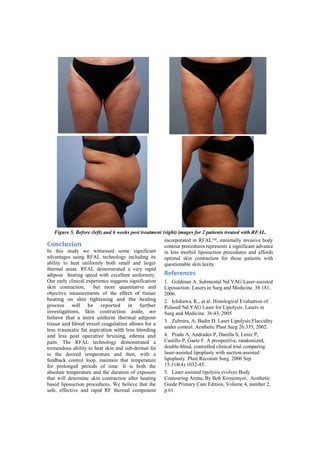 Figure 5. Before (left) and 6 weeks post treatment (right) images for 2 patients treated with RFAL.
                                                          incorporated in RFAL!, minimally invasive body
Conclusion!                                               contour procedures represents a significant advance
In this study we witnessed some significant               in less morbid liposuction procedures and affords
advantages using RFAL technology including its            optimal skin contraction for those patients with
ability to heat uniformly both small and larger           questionable skin laxity.
thermal areas. RFAL demonstrated a very rapid
adipose heating speed with excellent uniformity.          References!
Our early clinical experience suggests signification      1. Goldman A. Submental Nd:YAG Laser-assisted
skin contraction,       but more quantitative and         Liposuction. Lasers in Surg and Medicine. 38:181,
objective measurements of the! /::/-.! +:! .%,,#/!        2006.
2/(.%&'! +&! ,=%&! .%'2./&%&'! (&"! .2/! 2/()%&'!         2. Ichikawa, K., et al. Histological Evaluation of
*$+-/,,! K%))! A/! $/*+$./"! %&! :#$.2/$!                 Pulased Nd:YAG Laser for Lipolysis. Lasers in
%&>/,.%'(.%+&,0! 4=%&! -+&.$(-.%+&! (,%"/5! K/!           Surg and Medicine. 36:43, 2005
A/)%/>/! .2(.! (! ;+$/! #&%:+$;! .2/$;()! ("%*+,/!
                                                          3. Zulmira, A, Badin D. Laser Lipolysis:Flaccidity
.%,,#/!(&"!A)++"!>/,,/)!-+('#)(.%+&!())+K,!:+$!(!
                                                          under control. Aesthetic Plast Surg 26:335, 2002.
)/,,! .$(#;(.%-! :(.! (,*%$(.%+&! K%.2! )/,,! A)//"%&'!
(&"! )/,,! *+,.! +*/$(.%>/! A$#%,%&', /"/;(! (&"!         4. Prado A, Andrades P, Danilla S, Leniz P,
*(%&. The RFAL technology demonstrated a                  Castillo P, Gaete F. A prospective, randomized,
tremendous ability to heat skin and sub-dermal fat        double-blind, controlled clinical trial comparing
to the desired temperature and then, with a               laser-assisted lipoplasty with suction-assisted
feedback control loop, maintain that temperature          lipoplasty. Plast Reconstr Surg. 2006 Sep
for prolonged periods of time. It is both the             15;118(4):1032-45.
absolute temperature and the duration of exposure         5. Laser assisted lipolysis evolves Body
that will determine skin contraction after heating        Contouring Arena, By Bob Kronemyer, Aesthetic
based liposuction procedures. We believe that the         Guide Primary Care Edition, Volume 4, number 2,
safe, effective and rapid RF thermal component            p.61.
 