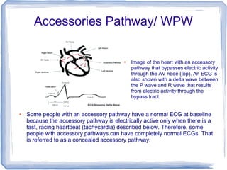 Accessories Pathway/ WPW
● Image of the heart with an accessory
pathway that bypasses electric activity
through the AV node (top). An ECG is
also shown with a delta wave between
the P wave and R wave that results
from electric activity through the
bypass tract.
● Some people with an accessory pathway have a normal ECG at baseline
because the accessory pathway is electrically active only when there is a
fast, racing heartbeat (tachycardia) described below. Therefore, some
people with accessory pathways can have completely normal ECGs. That
is referred to as a concealed accessory pathway.
 
