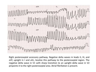 Localization of WPW( accessory Pathway) by surface ECG | PPTX