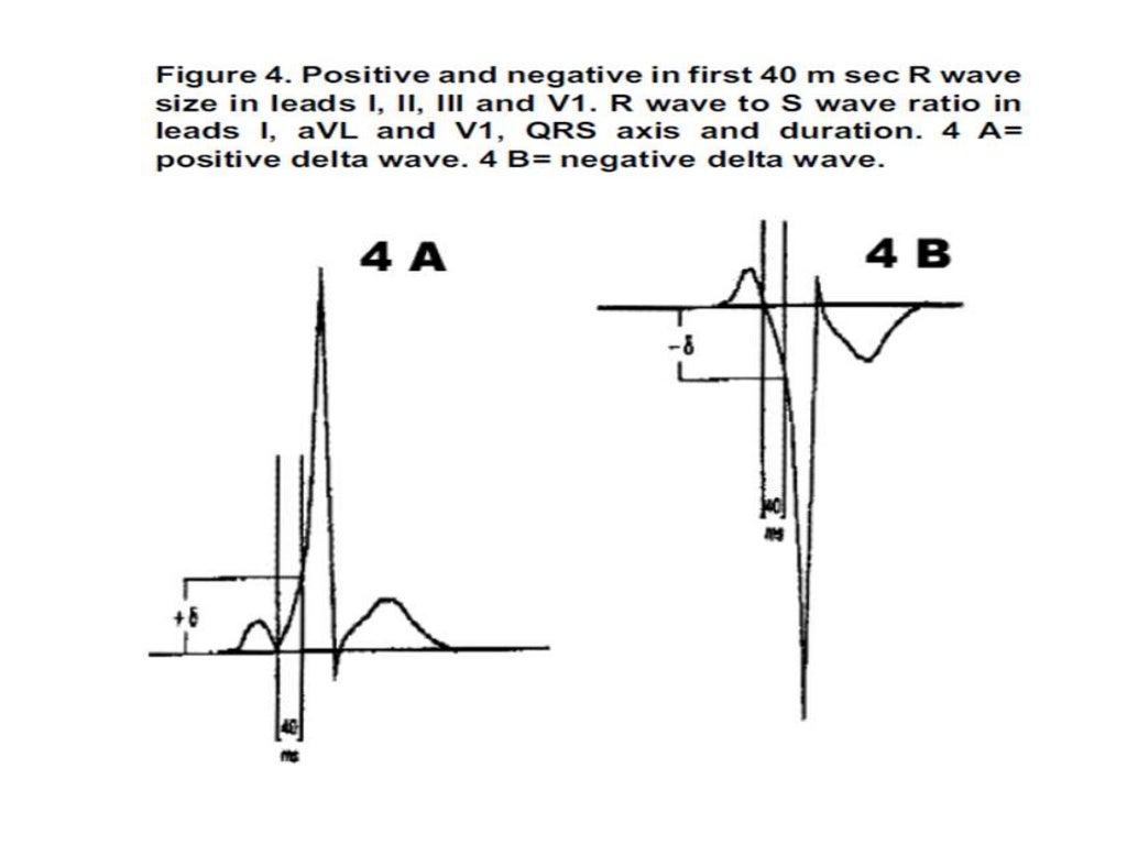 Localization of WPW( accessory Pathway) by surface ECG