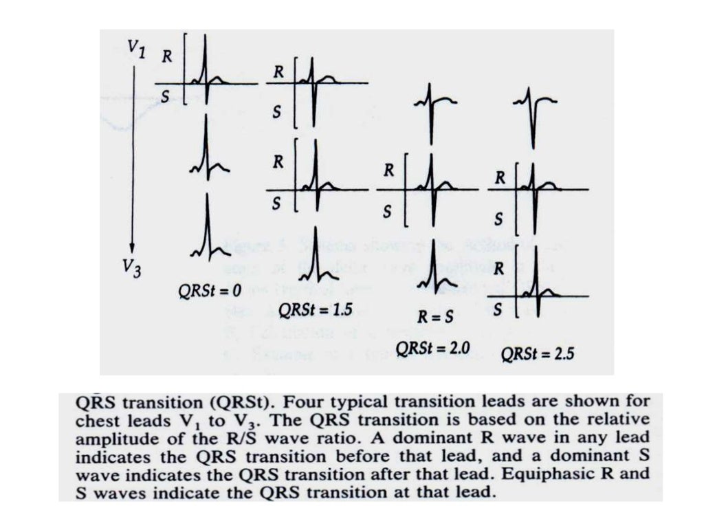 Localization of WPW( accessory Pathway) by surface ECG
