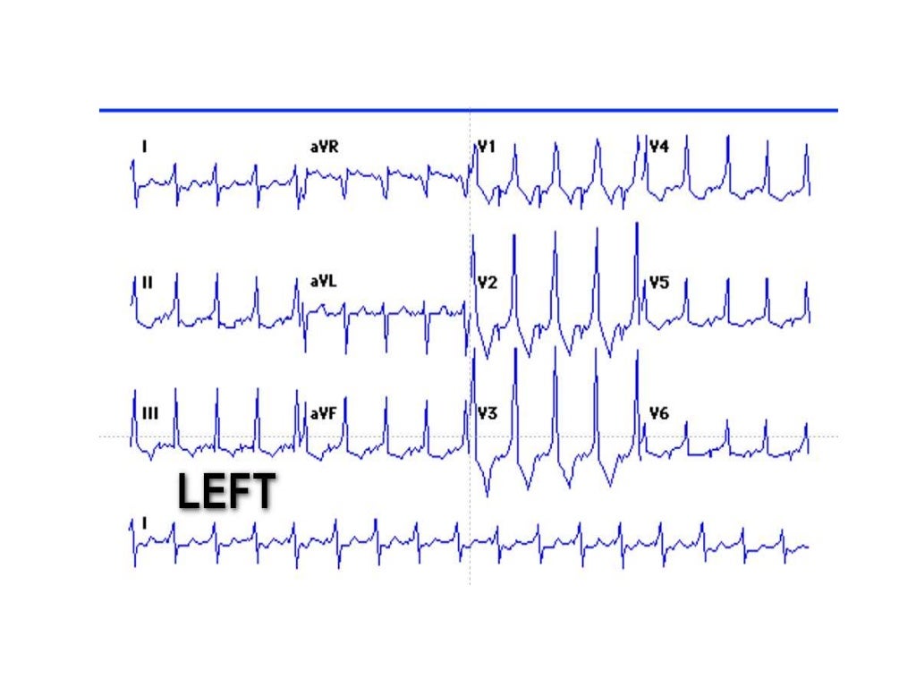 Localization of WPW( accessory Pathway) by surface ECG