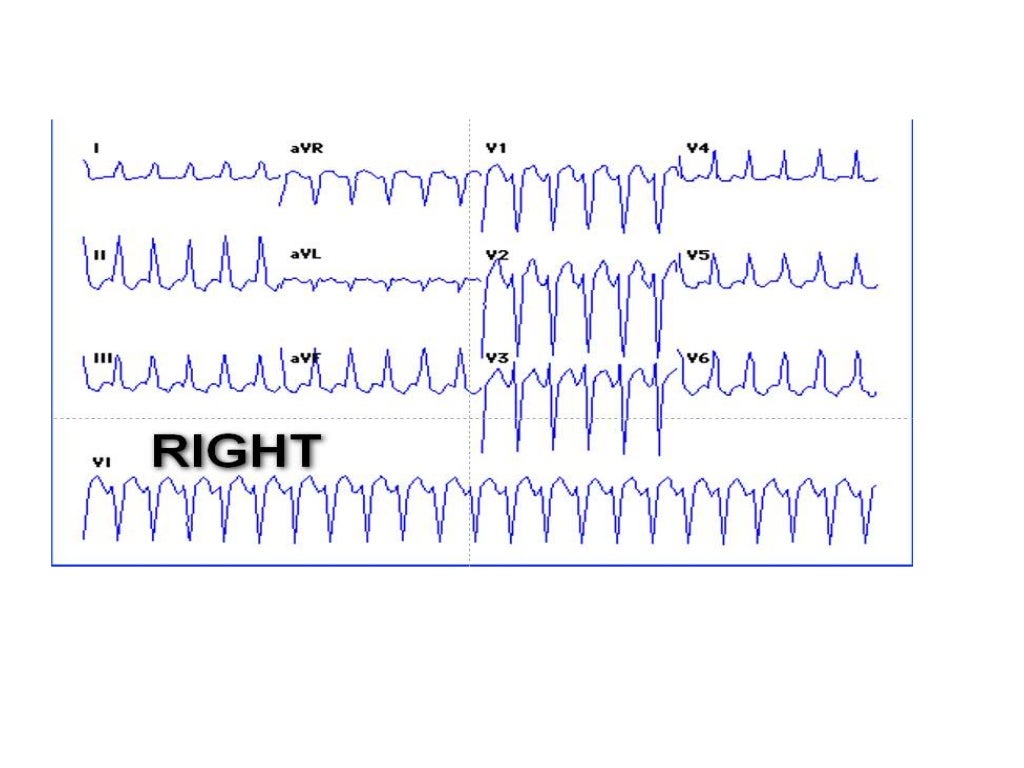 Localization of WPW( accessory Pathway) by surface ECG