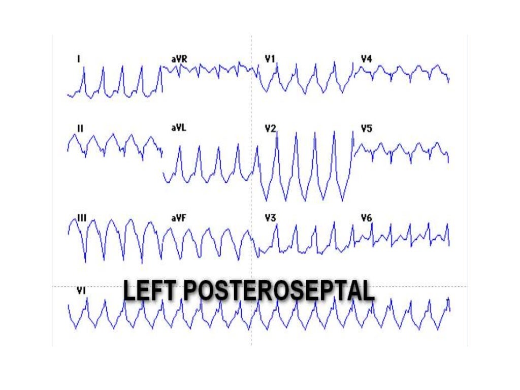 Localization of WPW( accessory Pathway) by surface ECG