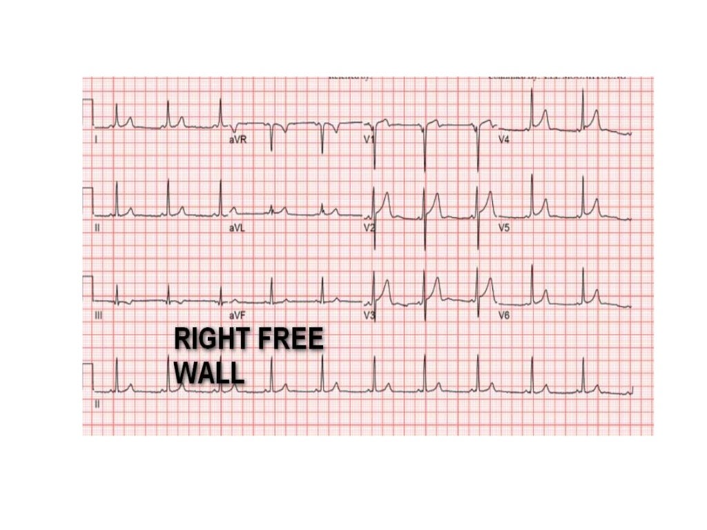 Localization of WPW( accessory Pathway) by surface ECG