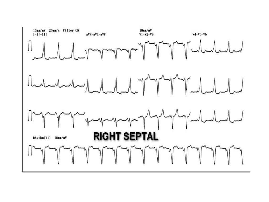 Localization of WPW( accessory Pathway) by surface ECG