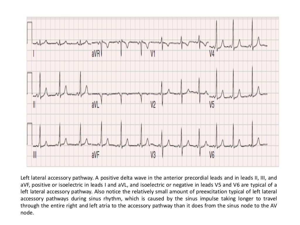 Localization of WPW( accessory Pathway) by surface ECG