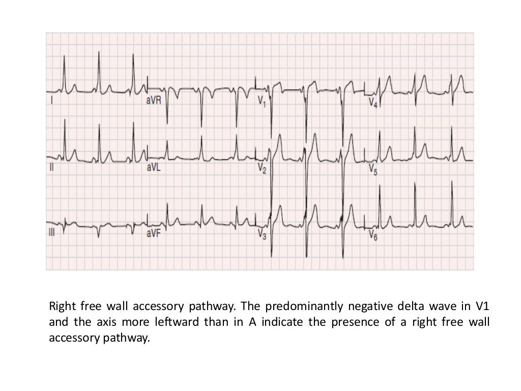 Localization of WPW( accessory Pathway) by surface ECG