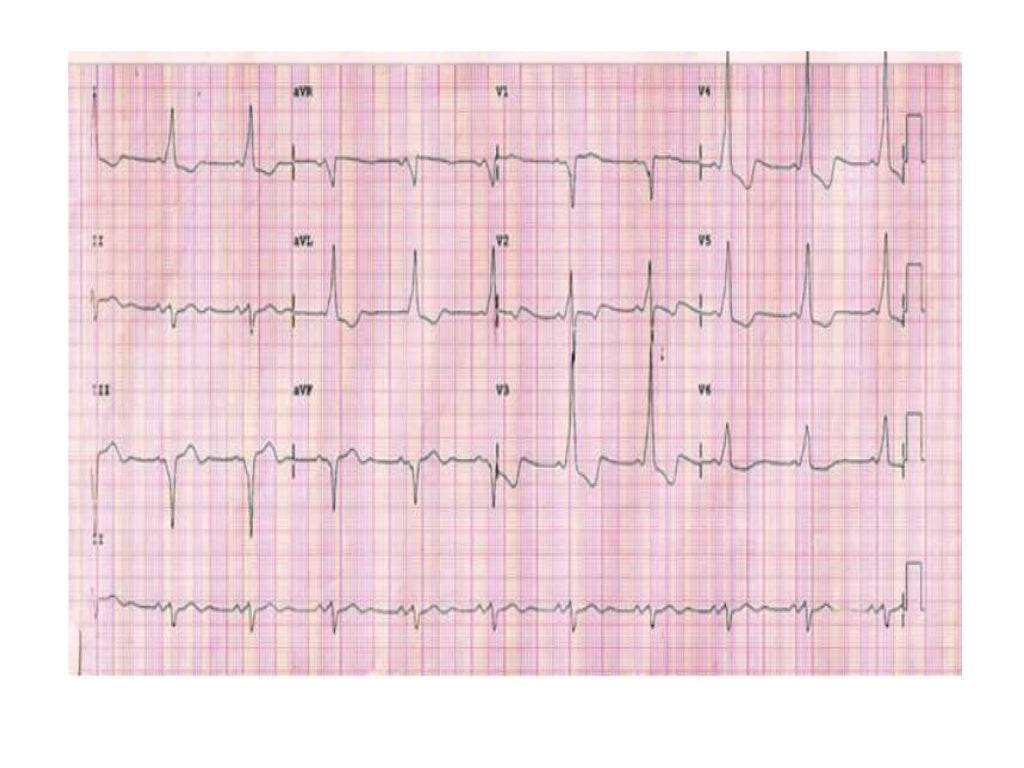 Localization of WPW( accessory Pathway) by surface ECG