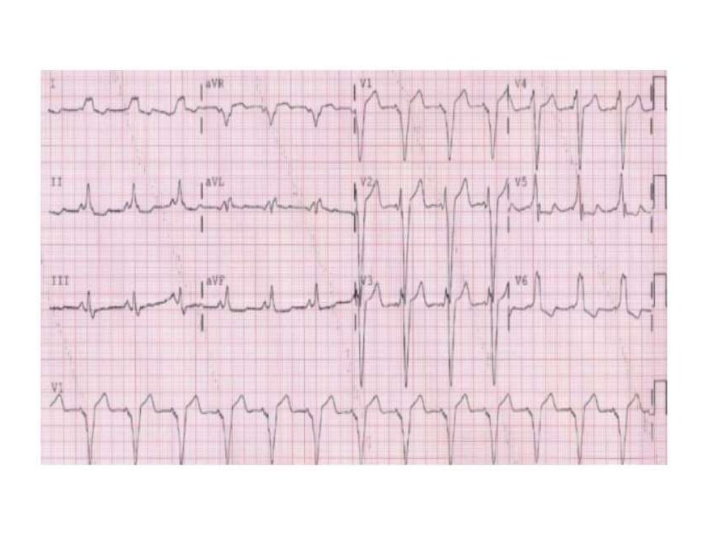 Localization of WPW( accessory Pathway) by surface ECG