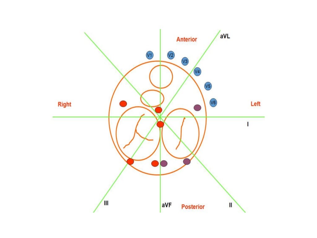 Localization of WPW( accessory Pathway) by surface ECG