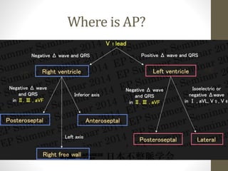 WPW syndrome | PPTX