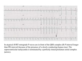 ECG localization of accessory pathways slideshare | PPTX