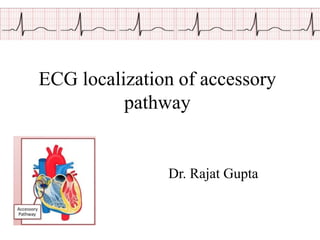 ECG localization of accessory
pathway
Dr. Rajat Gupta
 