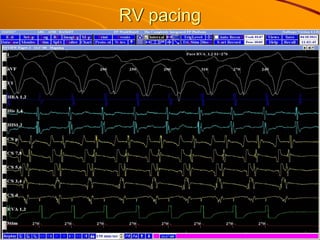 RV pacing