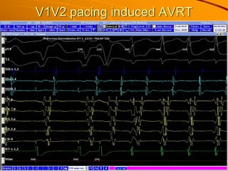 V1V2 pacing induced AVRT