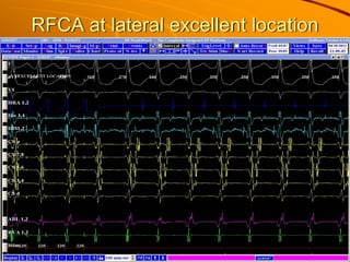 RFCA at lateral excellent location