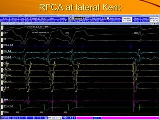 RFCA at lateral Kent