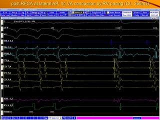 post RFCA at lateral AP: no VA conduction by RV pacing (CL: 350ms)