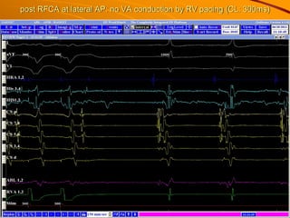 post RFCA at lateral AP: no VA conduction by RV pacing (CL: 300ms)