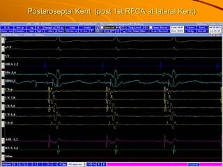 Posteroseptal Kent (post 1st RFCA at lateral Kent)