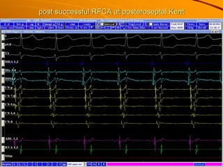 post successful RFCA at posteroseptal Kent