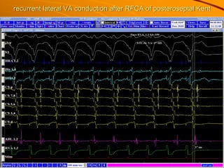 recurrent lateral VA conduction after RFCA of posteroseptal Kent