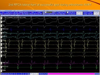 2nd RFCA lateral Kent at successful spot during orthodromic AVRT