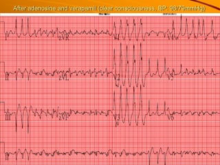 After adenosine and verapamil (clear consciousness, BP: 98/79mmHg)