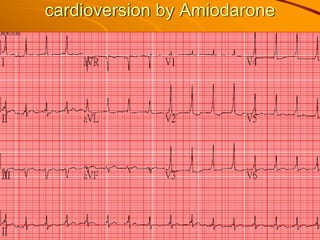 cardioversion by Amiodarone