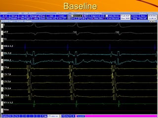 Baseline