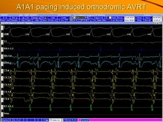 A1A1 pacing induced orthodromic AVRT