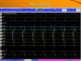 RA pacing