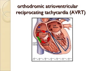 orthodromic atrioventricularorthodromic atrioventricular
reciprocating tachycardia (AVRT)reciprocating tachycardia (AVRT)
 