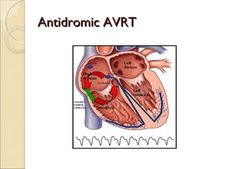 Antidromic AVRTAntidromic AVRT
 