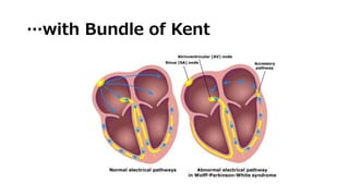 …with Bundle of Kent
 