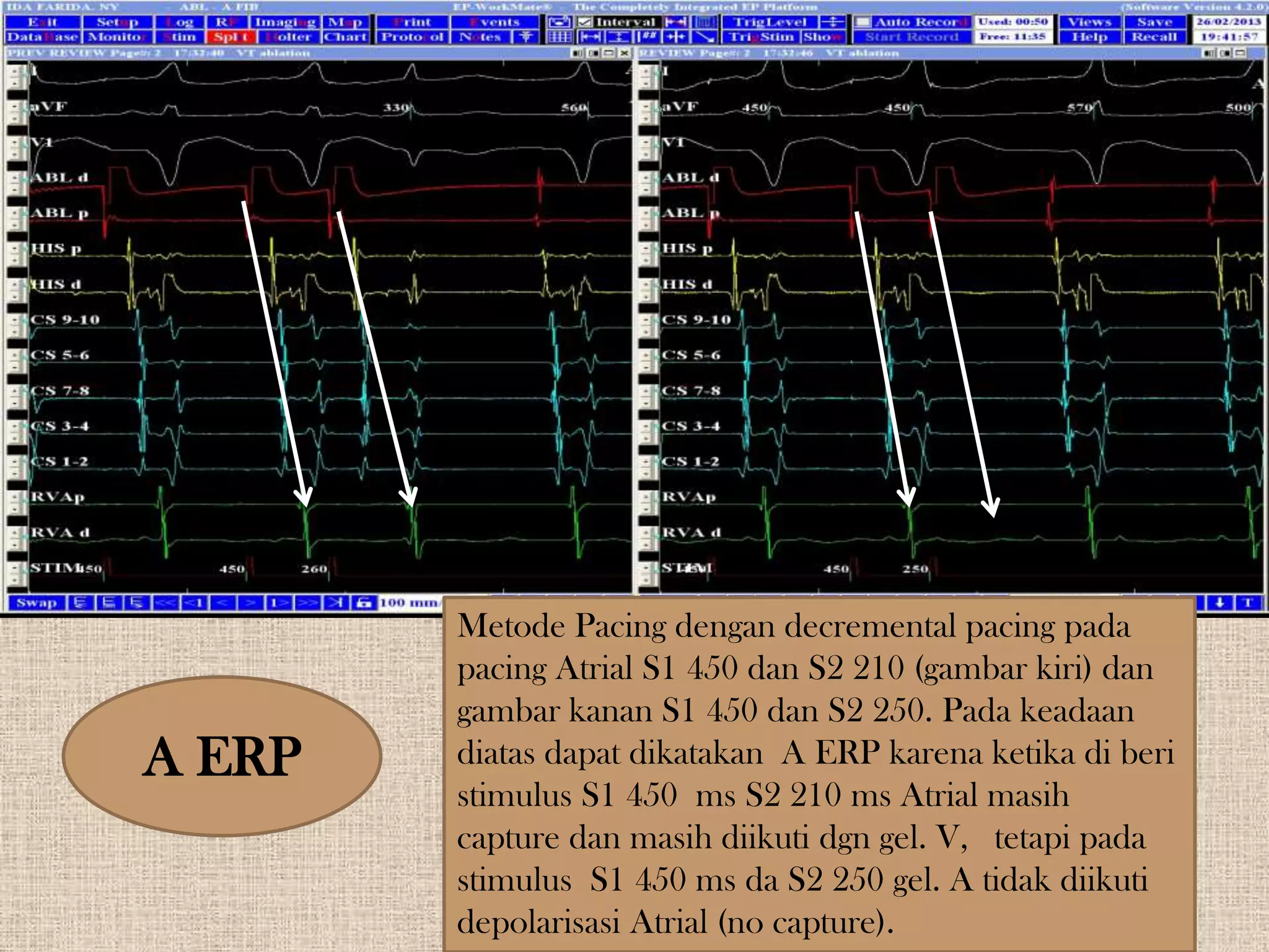 Wpw syndrome jadi | PPTX