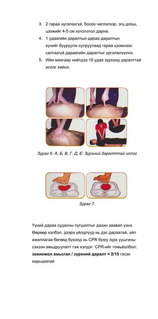 3. 2 гараа нугалахгүй, босоо чиглэлээр, эгц доош,
цээжийг 4-5 см хотолзтол дарна.
4. 1 удаагийн даралтын дараа даралтын
хүчийг бууруулж сулруулаад гараа цээжнээс
салгахгүй дараагийн даралтыг үргэлжлүүлнэ.
5. Ийм маягаар нийтдээ 15 удаа зүрхэнд даралттай
иллэг хийнэ.
Зураг 6. А, Б, В, Г, Д, Е: Зүрхний даралттай иллэг
Зураг 7.
Үүний дараа судасны лугшилтыг дахин заавал үзнэ.
Өөрөөр хэлбэл, дээрх үйлдлүүд нь дэс дараатай, үйл
ажиллагаа бөгөөд бүхэлд нь CPR буюу зүрх уушгины
сэхээн амьдруулалт гэж хэлдэг. CPR-ийг томьёолбол:
зохиомол амьсгал / зүрхний даралт = 2/15 гэсэн
харьцаатай
 