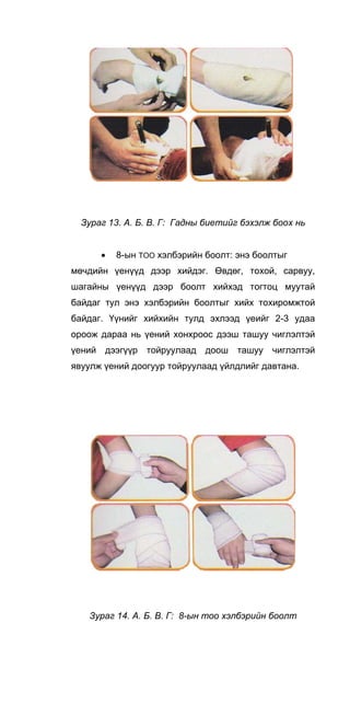 Зураг 13. А. Б. В. Г: Гадны биетийг бэхэлж боох нь
• 8-ын TOO хэлбэрийн боолт: энэ боолтыг
мөчдийн үенүүд дээр хийдэг. Өвдөг, тохой, сарвуу,
шагайны үенүүд дээр боолт хийхэд тогтоц муутай
байдаг тул энэ хэлбэрийн боолтыг хийх тохиромжтой
байдаг. Үүнийг хийхийн тулд эхлээд үеийг 2-3 удаа
ороож дараа нь үений хонхроос дээш ташуу чиглэлтэй
үений дээгүүр тойруулаад доош ташуу чиглэлтэй
явуулж үений доогуур тойруулаад үйлдлийг давтана.
Зураг 14. А. Б. В. Г: 8-ын тоо хэлбэрийн боолт
 