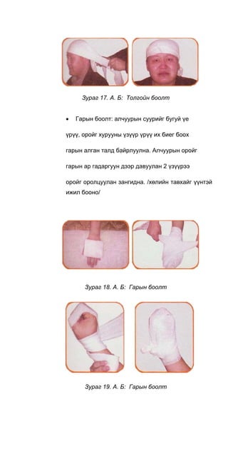 Зураг 17. А. Б: Толгойн боолт
• Гарын боолт: алчуурын суурийг бугуй үе
үрүү, оройг хурууны үзүүр үрүү их биег боох
гарын алган талд байрлуулна. Алчуурын оройг
гарын ар гадаргуун дээр давуулан 2 үзүүрээ
оройг оролцуулан зангидна. /хөлийн тавхайг үүнтэй
ижил бооно/
Зураг 18. А. Б: Гарын боолт
Зураг 19. А. Б: Гарын боолт
 