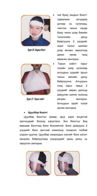 • чих буюу хацрын боолт:
гурвалжин алчуураа
уртаар нь нугалаад,
гэмтсэн талын хацар
буюу чихэн дээр биеийн
тэнхлэгийн дагуу
байрлуулж 2 үзүүрийг
эсрэг талын шанаан
дээр авчирч зөрүүлээд
дахин нөгөө талд
аваачин зангидна.
• Гарын сойлт: гарыг
тохойн үеэр нугалаад
алчуурын суурийг эрүүл
талын мөчийн дагуу
байрлуулна. Алчуурын
голд гарыг тавьж 2
үзүүрийг мөрөн дээгүүр
давуулан шилэн хүзүүнд
авчран зангидна.
Алчуурын оройг тохой
орчим зангидна.
• Цуулбар боолт:
Цуулбар боолтыг хамар, эрүү зэрэг өнцөгтэй
эрхтнүүдийг бооход хэрэглэнэ. Энэ боолтыг бид
өөрсдөө бэлтгээд боох боломжтой. Боох даавууны 2
үзүүрийг боох эрхтний хэмжээнд тохирсон талбай
үлдээн цуулна. Цуулбар хоорондын хэсгийг боох хэсэгт
хөндлөн байрлуулаад үзүүрүүдийг дээш доош нь
зөрүүлэн зангидна.
 