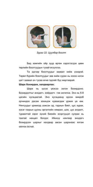 Зураг 22. Цуулбар боолт
Бид хамгийн ойр зуур өргөн хэрэглэгдэх цөөн
төрлийн боолтуудын тухай өгүүллээ.
Та эдгээр боолтуудыг заавал хийж үзээрэй.
Төрөл бүрийн боолтуудыг зөв хийж сурах нь хэзээ нэгэн
цагт заавал ач тусаа өгнө гэдгийг бүү мартаарай.
Шарх бохирдох, халдварлах:
Шapx нь үүсэх үеэсээ эхлэн бохирдоно.
Бохирдолтыг анхдагч. хоёрдогч гэж ангилна. Энэ нь 6-8
цагийн хугацаатай. Энэ хугацаанд орсон микроб
орчиндоо дасаж зохицож хуваагдаж үржих үе юм.
Нянгуудыг үржихэд үхжсэн эд, гаднын биет, цус хурах,
хэсэг газрын цусны эргэлтийн хямрал, шок, цус алдалт,
тураалтай зэрэг хүний биеийн эсэргүүцэл сулрах нь
таатай нөхцөл болдог. Ийнхүү нянгаар анхдагч
бохирдсон шархыг халдвар авсан шархнаас ялгаж
ойлгох ёстой.
 