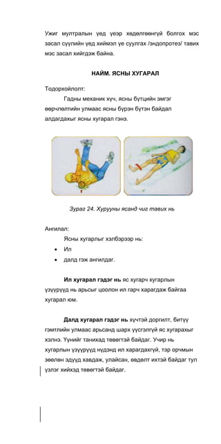 Ужиг мултралын үед үеэр хөдөлгөөнгүй болгох мэс
засал сүүлийн үед хиймэл үе суулгах /эндопротез/ тавих
мэс засал хийгдэж байна.
НАЙМ. ЯСНЫ ХУГАРАЛ
Тодорхойлолт:
Гадны механик хүч, ясны бүтцийн эмгэг
өөрчлөлтийн улмаас ясны бүрэн бүтэн байдал
алдагдахыг ясны хугарал гэнэ.
Зураг 24. Хурууны ясанд чиг тавих нь
Ангилал:
Ясны хугарлыг хэлбэрээр нь:
• Ил
• далд гэж ангилдаг.
Ил хугарал гэдэг нь яс хугарч хугарлын
үзүүрүүд нь арьсыг цоолон ил гарч харагдаж байгаа
хугарал юм.
Далд хугарал гэдэг нь хүчтэй доргилт, битүү
гэмтлийн улмаас арьсанд шарх үүсгэлгүй яс хугарахыг
хэлнэ. Үүнийг танихад төвөгтэй байдаг. Учир нь
хугарлын үзүүрүүд нүдэнд ил харагдахгүй, тэр орчмын
зөөлөн эдүүд хавдаж, улайсан, өвдөлт ихтэй байдаг тул
үзлэг хийхэд төвөгтэй байдаг.
 