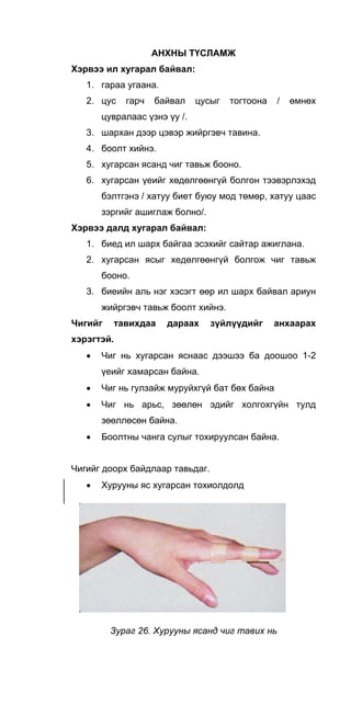 АНХНЫ ТҮСЛАМЖ
Хэрвээ ил хугарал байвал:
1. гараа угаана.
2. цус гарч байвал цусыг тогтоона / өмнөх
цувралаас үзнэ үу /.
3. шархан дээр цэвэр жийргэвч тавина.
4. боолт хийнэ.
5. хугарсан ясанд чиг тавьж бооно.
6. хугарсан үеийг хөдөлгөөнгүй болгон тээвэрлэхэд
бэлтгэнэ / хатуу биет буюу мод төмөр, хатуу цаас
зэргийг ашиглаж болно/.
Хэрвээ далд хугарал байвал:
1. биед ил шарх байгаа эсэхийг сайтар ажиглана.
2. хугарсан ясыг хедөлгөөнгүй болгож чиг тавьж
бооно.
3. биеийн аль нэг хэсэгт өөр ил шарх байвал ариун
жийргэвч тавьж боолт хийнэ.
Чигийг тавихдаа дараах зүйлүүдийг анхаарах
хэрэгтэй.
• Чиг нь хугарсан яснаас дээшээ ба доошоо 1-2
үеийг хамарсан байна.
• Чиг нь гулзайж муруйхгүй бат бөх байна
• Чиг нь арьс, зөөлөн эдийг холгохгүйн тулд
зөөллөсөн байна.
• Боолтны чанга сулыг тохируулсан байна.
Чигийг доорх байдлаар тавьдаг.
• Хурууны яс хугарсан тохиолдолд
Зураг 26. Хурууны ясанд чиг тавих нь
 